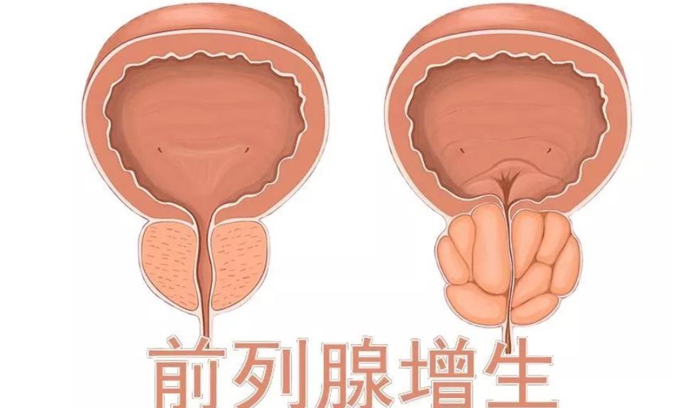 前列腺增生出现下列情况及时就医,前列腺增生什么情况吃什么药