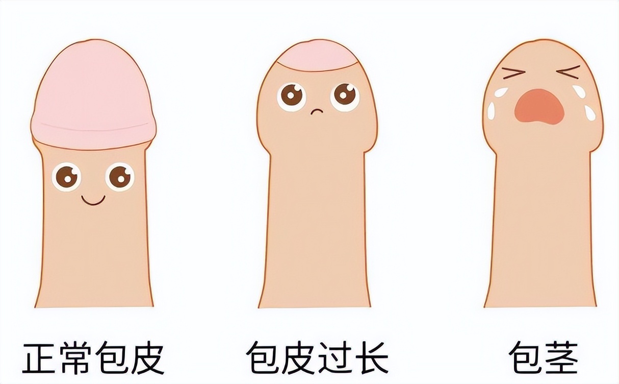 割包皮推荐几月去,暑假割包皮高峰期