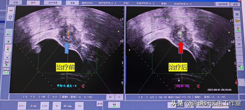 未婚未育子宫肌瘤该如何处理？