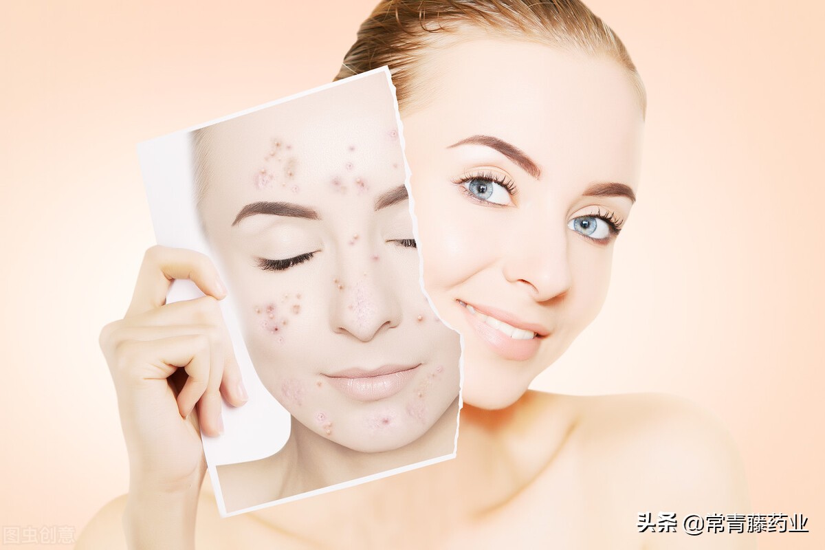 异维a酸胶囊脂肪肝可以吃吗,有脂肪肝吃异维a酸有影响吗