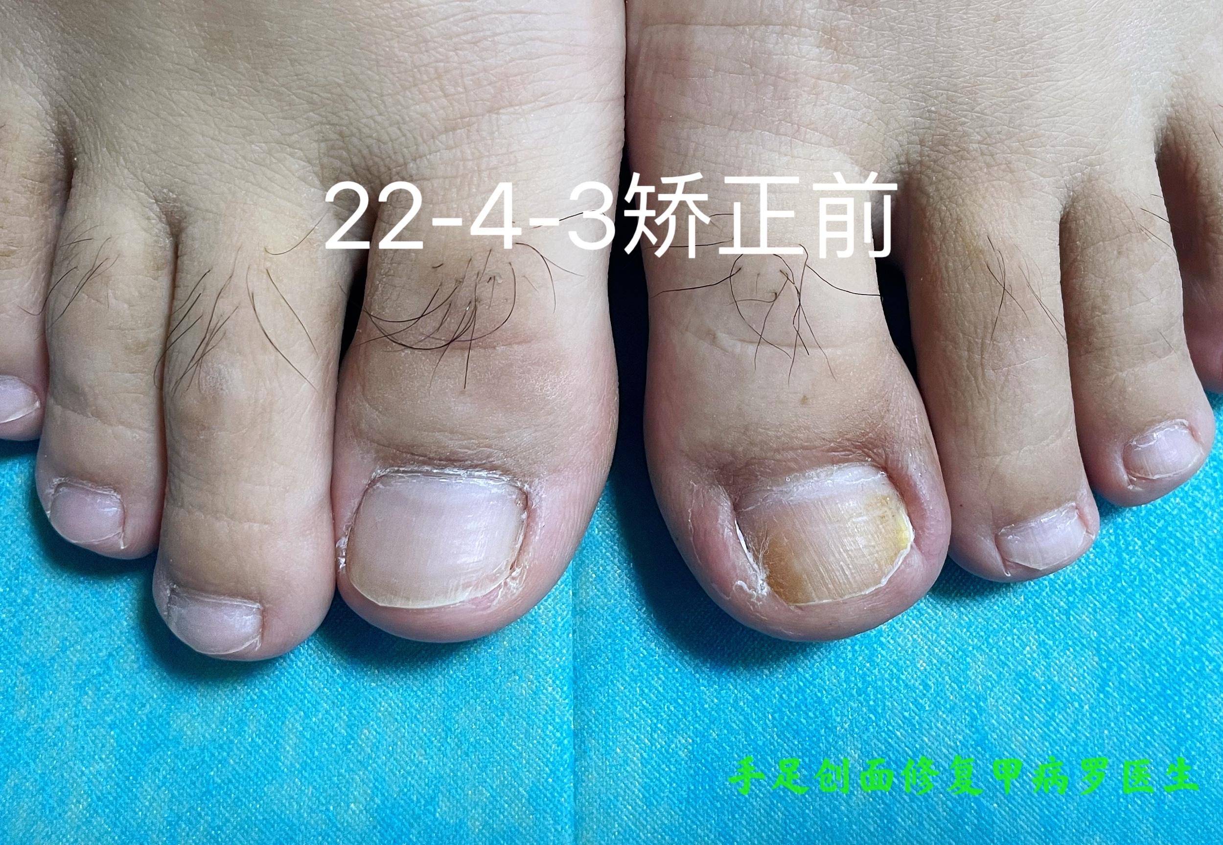 甲沟炎十年,有史以来最严重的甲沟炎