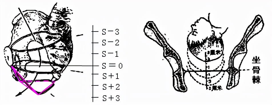 孕妈妈怎么判断胎位是正的,胎儿屁股在右侧是什么胎位