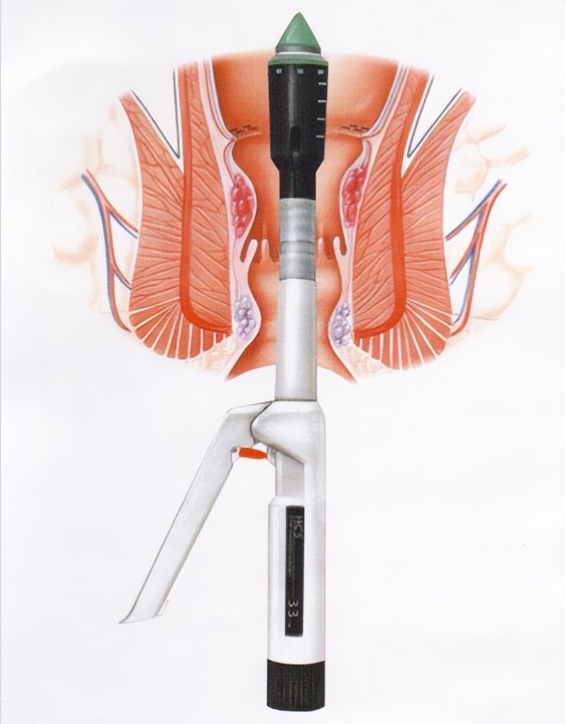 割痔疮痛还是生孩子顺产痛,割痔疮和生孩子哪个疼