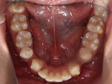 拔牙矫正后多长时间能合缝,拔牙矫正需要缝线吗