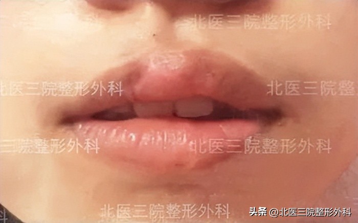 上嘴唇缺一块怎么修补,上嘴唇缺损
