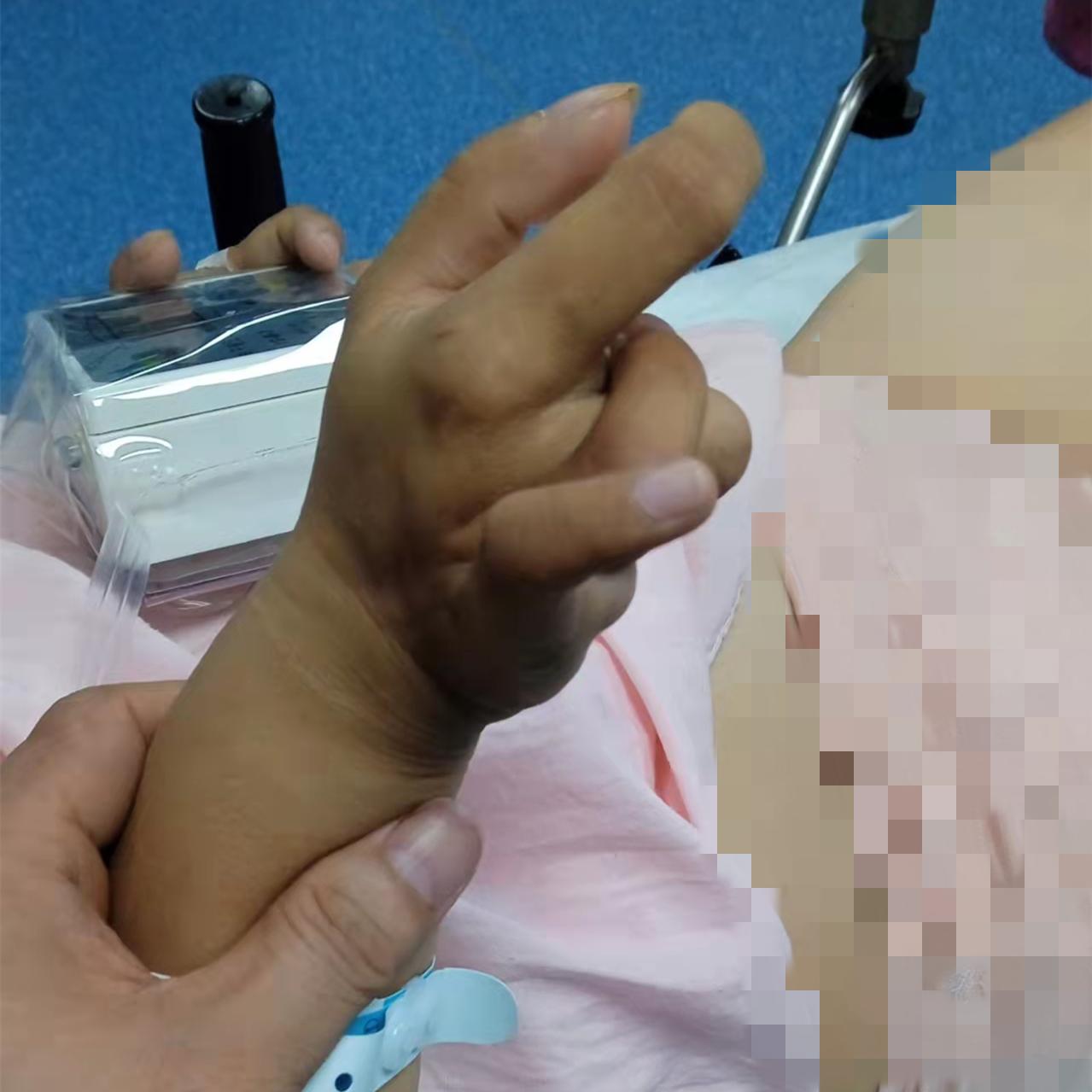 矮小症产妇一样可以享受到无痛分娩的好处了