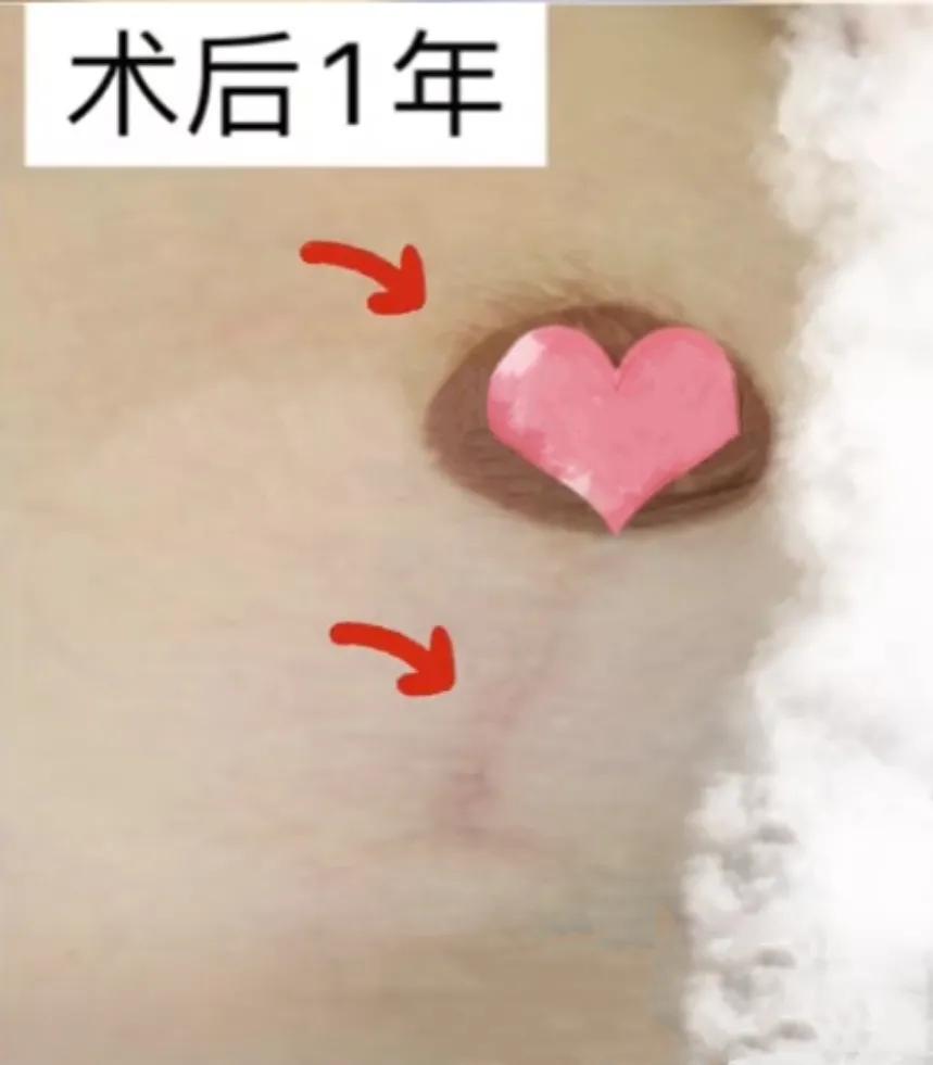 乳房缩小手术要多长时间才能恢复,乳房缩小上提手术后伤口不愈合