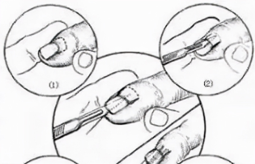 灰指甲怎样才能彻底根除用什么药,脚上灰指甲怎么才能彻底根治