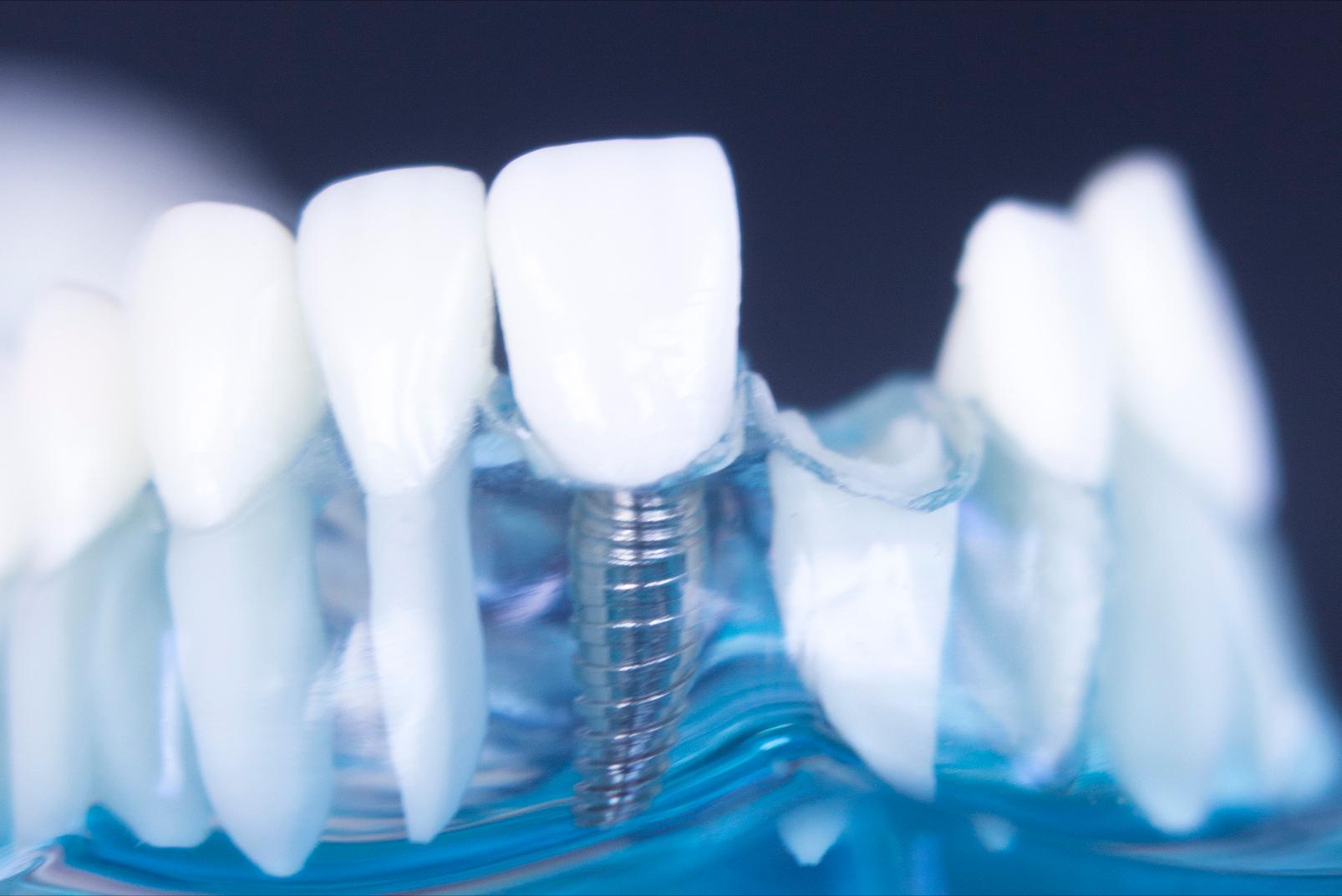 牙齿贴面什么材质经济又耐用,牙齿瓷贴面哪家做的好