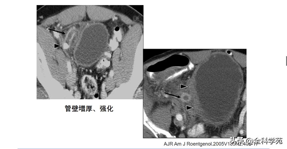 阑尾炎的讲解,关于阑尾炎的讨论总结