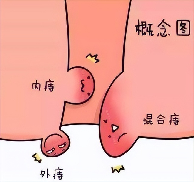 十女九痔！送你一方，理气止血，去湿热，修复黏膜，化解痔疮