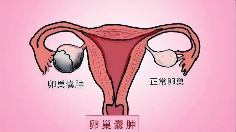 卵巢囊肿是气血亏虚引起的吗,脾肾湿寒卵巢囊肿怎么调理