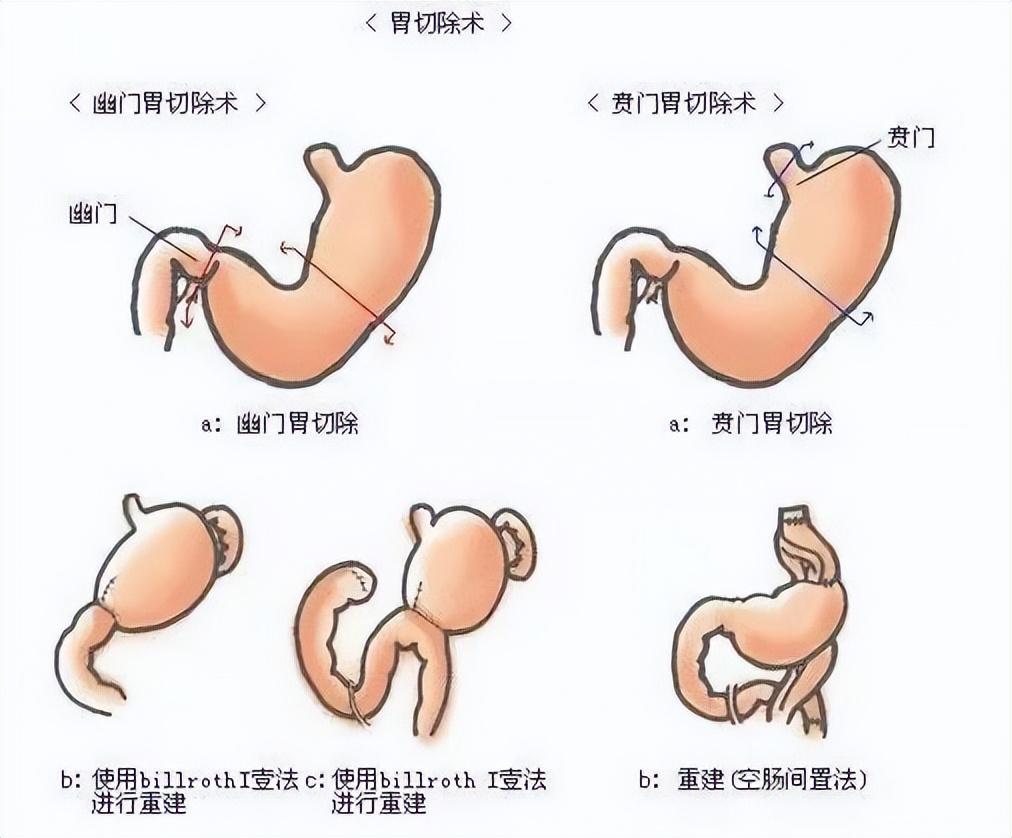 8年前，江西14岁体重300斤少年求救，希望医生让我活下去