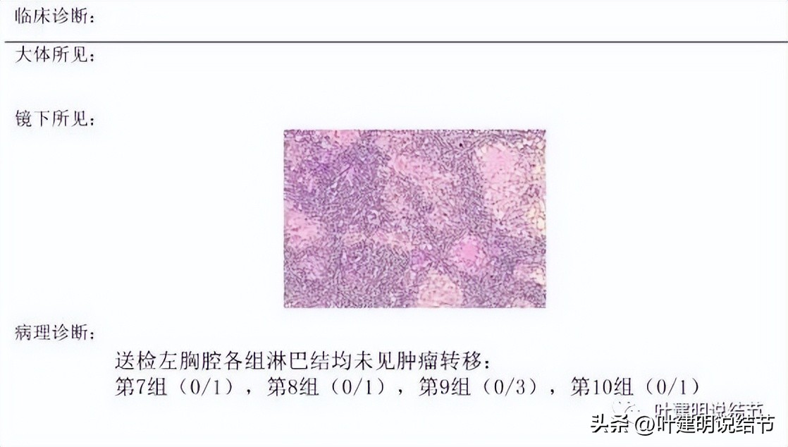 辽宁省肺结节手术哪家医院好,辽宁肺结节手术医院