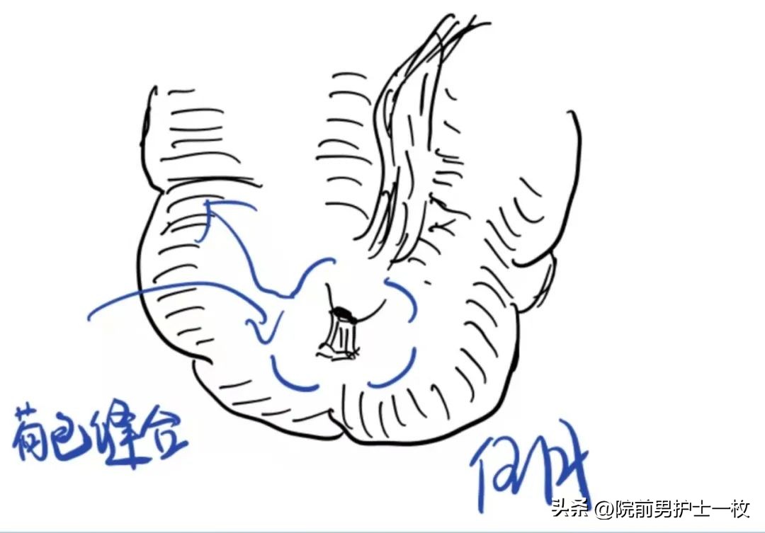 关于急诊清创缝合术必须掌握知识