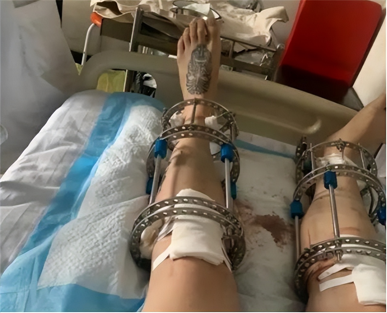 断骨增高的李亚诺是哪里人,李亚诺截骨长高是真人真事吗