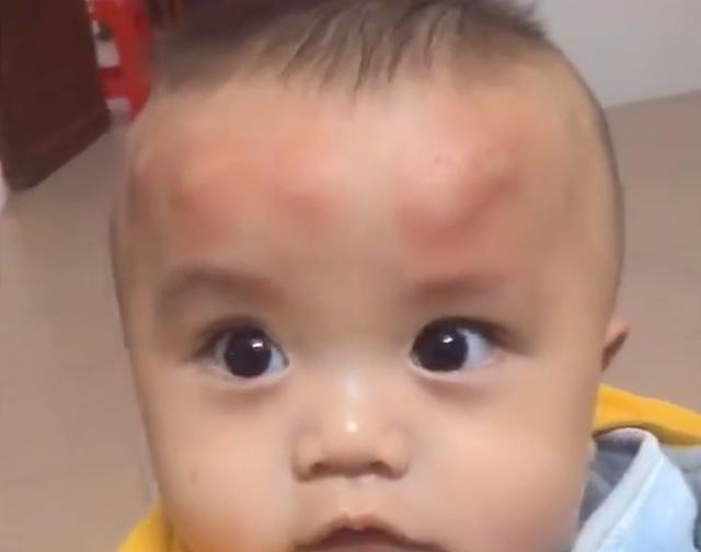 广东一萌娃一觉醒来头上长了一圈包，网友心疼：蚊子一家来开餐吗