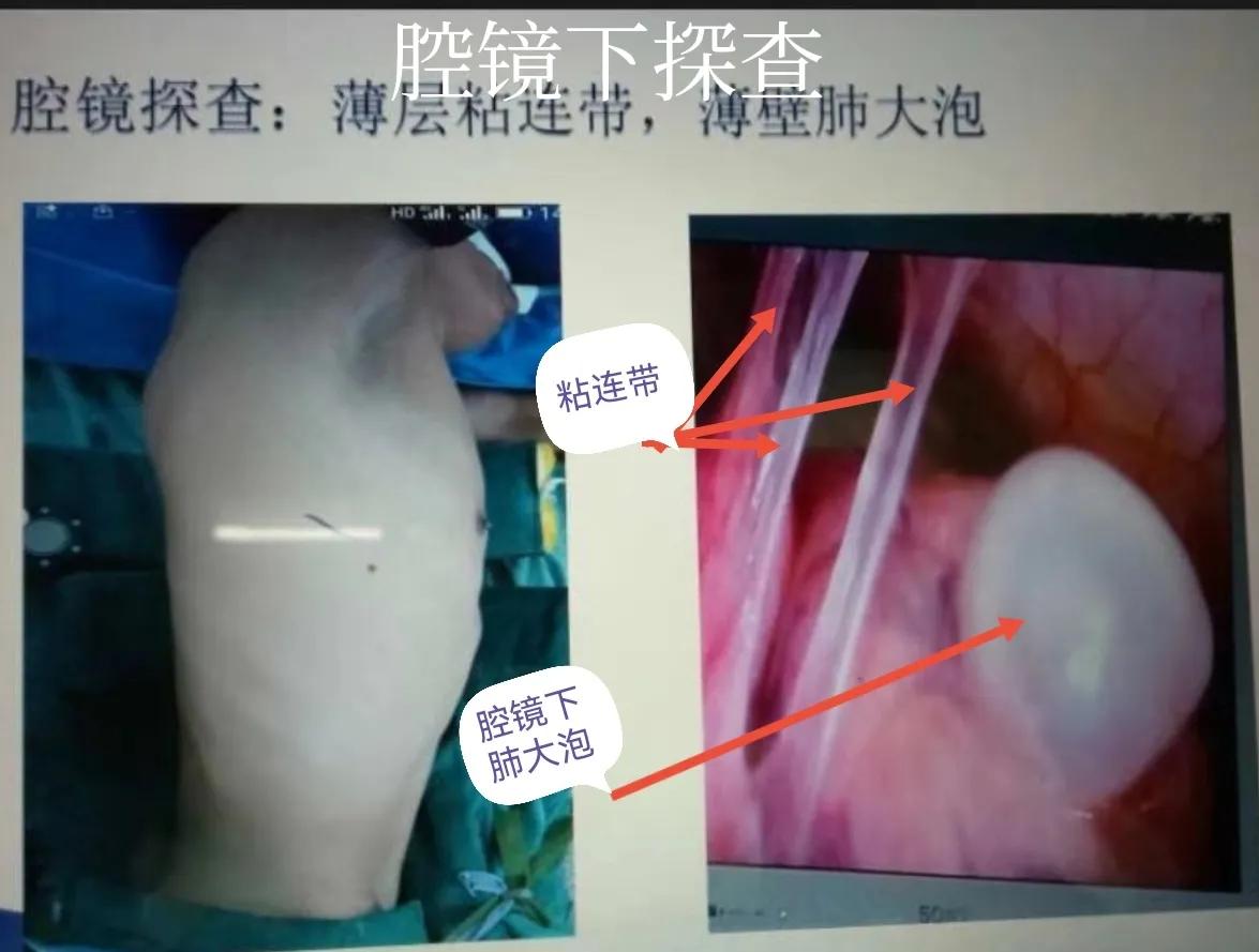 肺大泡产生的原因及治疗方案,肺大泡怎么治疗断根