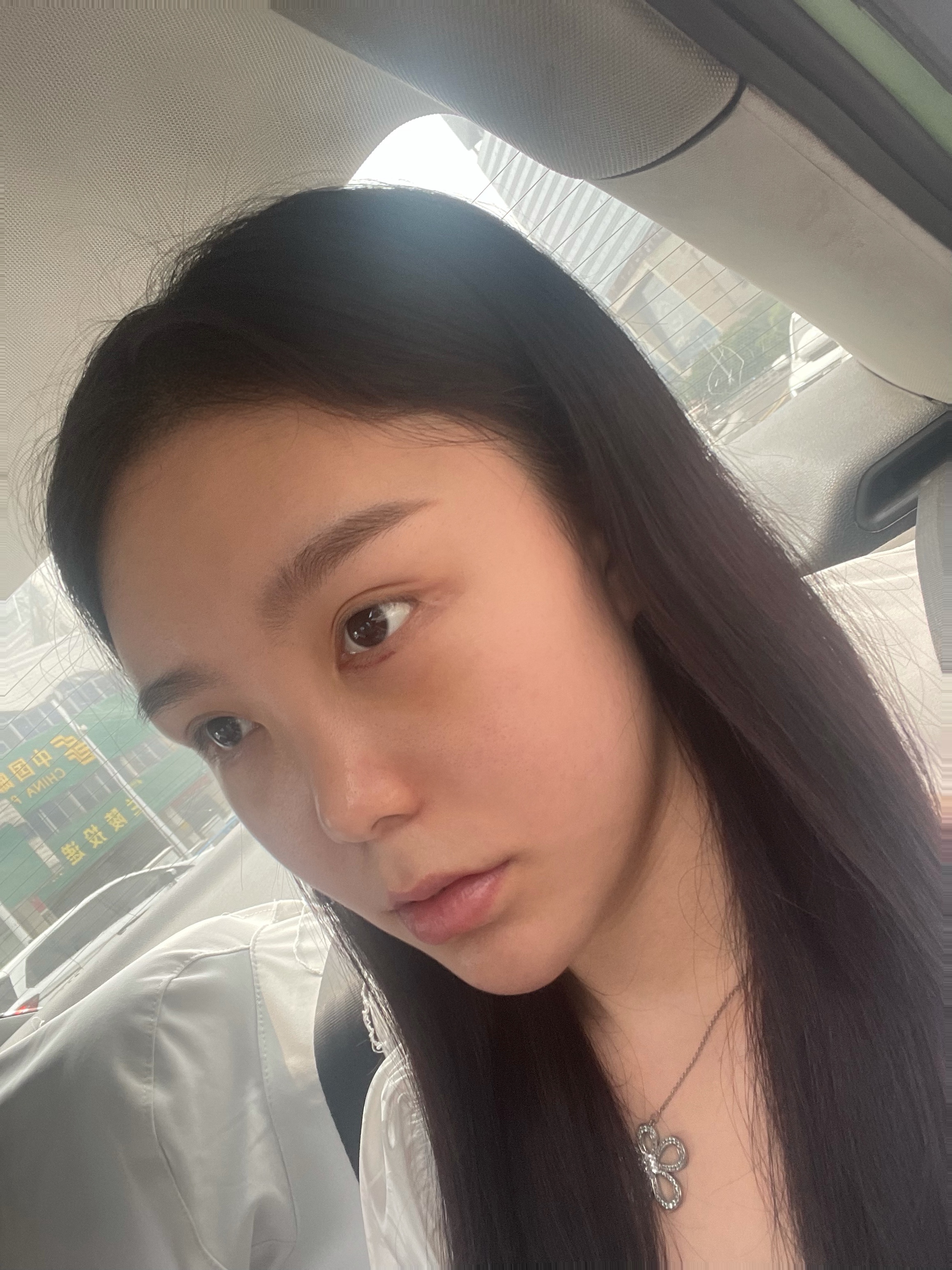 上海第九人民医院不开刀去除眼袋,顽固眼袋别担心不开刀也能变好看