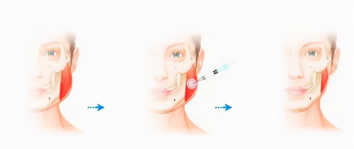 注射瘦脸针消除咬肌,打完瘦脸针会面部凹陷吗