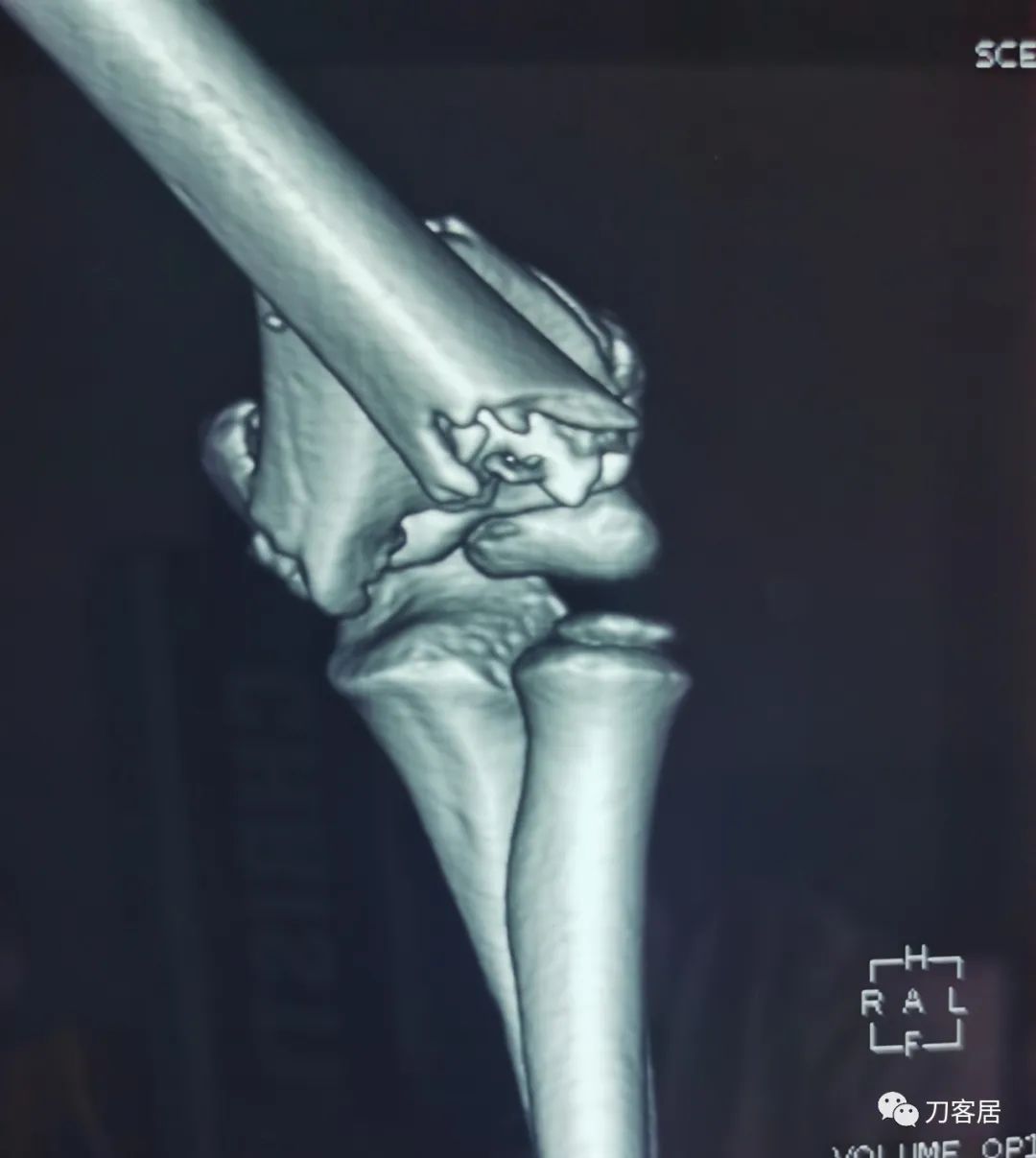 孩子胳膊摔伤肿了不能弯曲一直疼,9岁男孩摔倒手臂痛怎么办