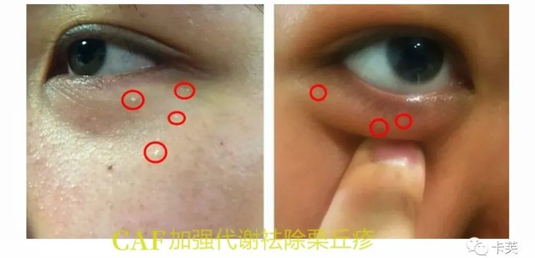 羊胚胎素冻干冰晶眼部精华液，平干纹，淡黑圈，收眼袋，美目传情