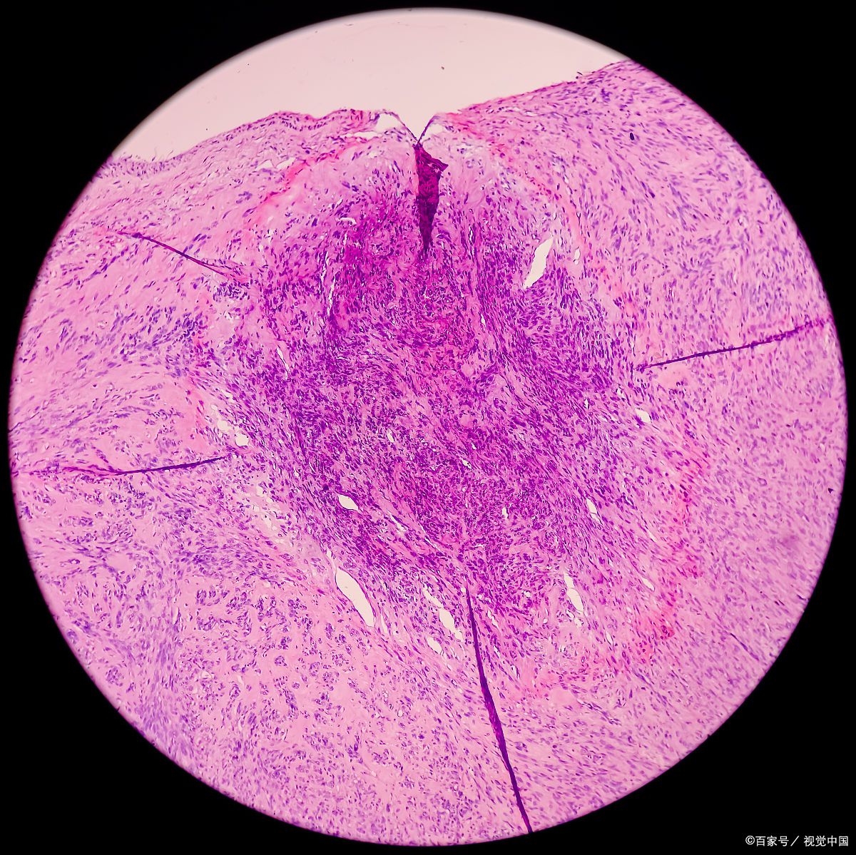 子宫肌瘤热消融治疗的优缺点,子宫肌瘤用热消融术打麻药吗