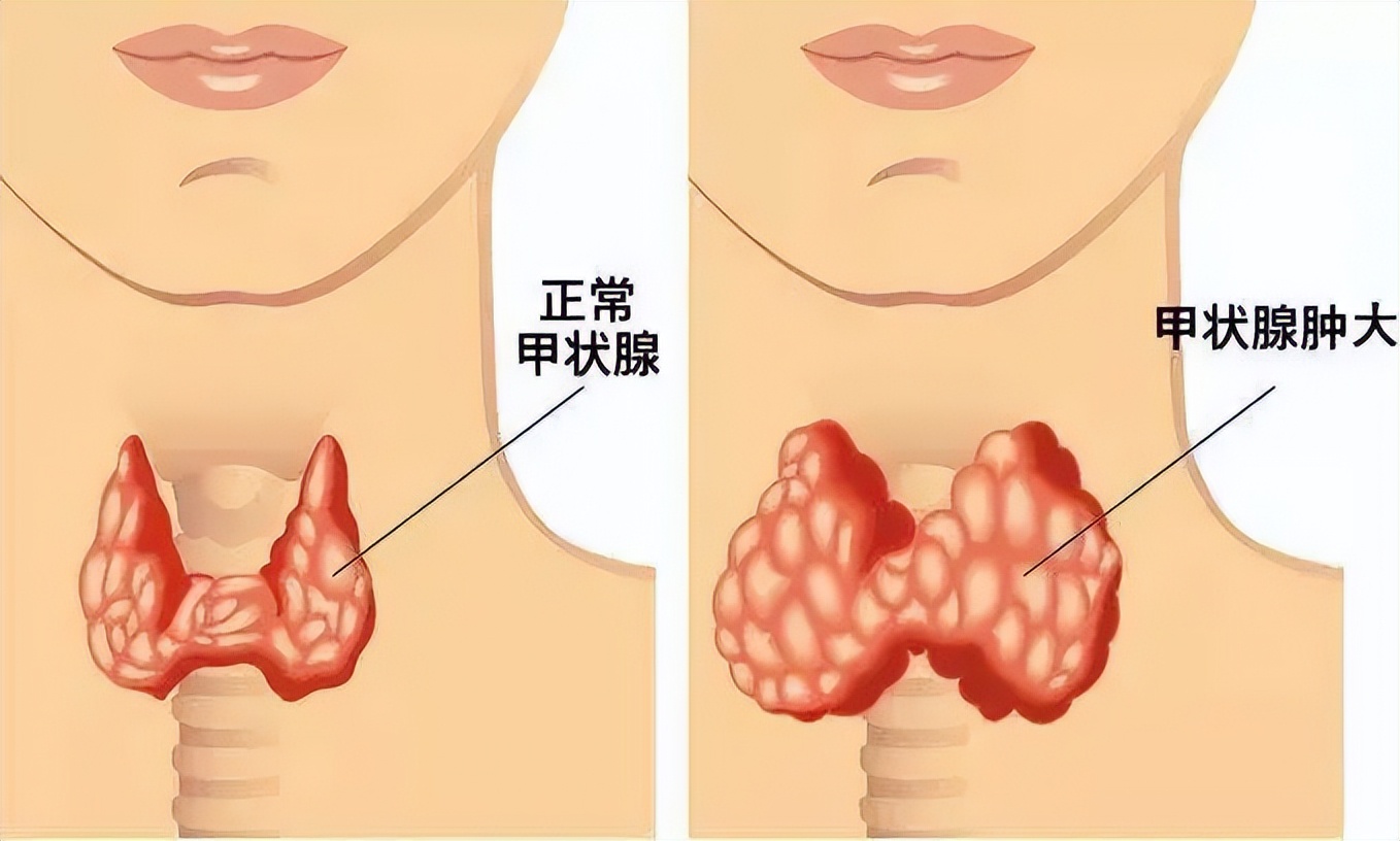 10个人里3个中招！体检发现甲状腺结节咋办？