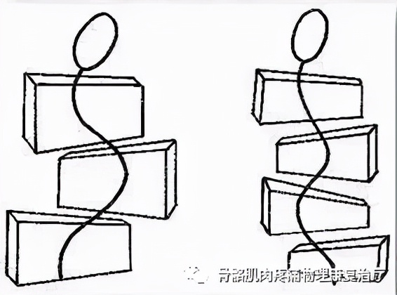 脊柱侧弯23度施罗斯矫正有用吗,非结构性脊柱侧弯