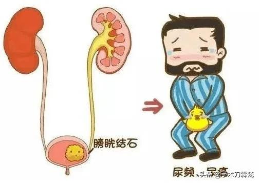 泌尿系结石注意什么,泌尿道结石吃什么中成药