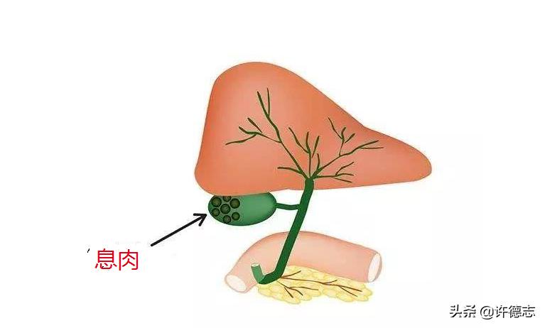 40岁女人胆囊息肉消失案例,关于胆囊息肉的视频