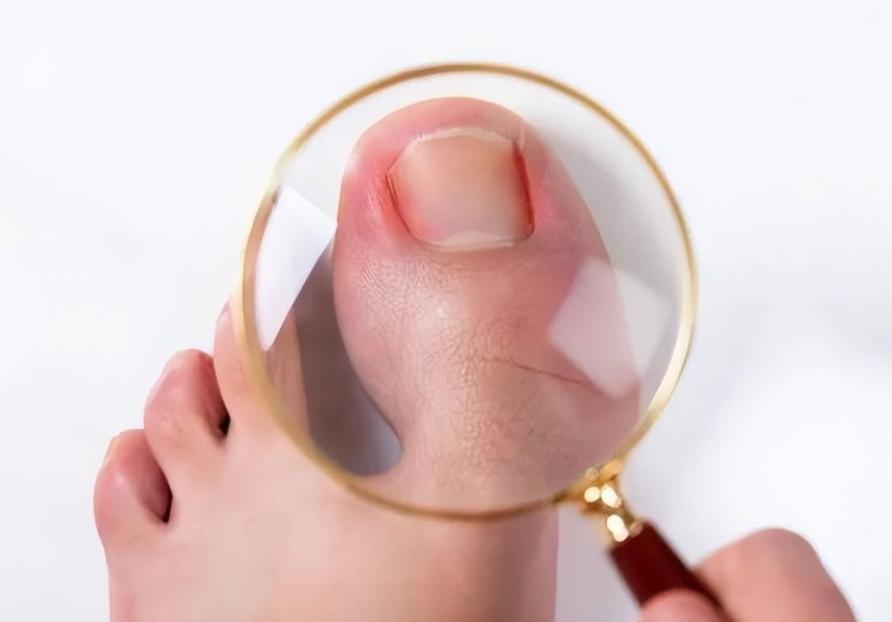 脚趾甲老往肉里钻，一碰还疼？教你小妙招，预防甲沟炎告别疼痛