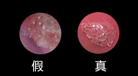 为爱鼓掌时，发现女友*体下**长疙瘩，是尖锐湿疣？