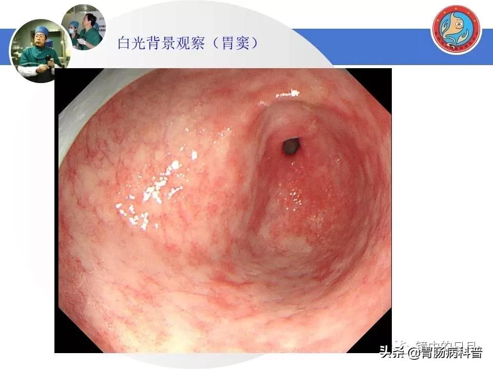 胃癌可以做内镜手术吗,早期胃癌内镜手术后追加外科手术