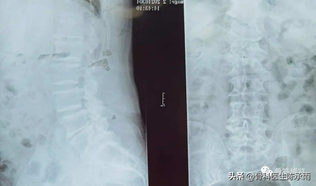 腰椎滑脱椎管狭窄手术后遗症,腰椎间盘突出椎管狭窄的手术