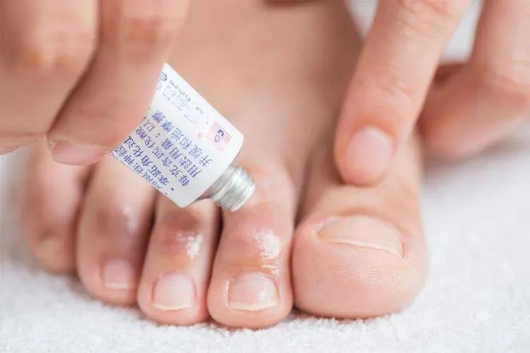 “脚气”真菌怎么治才能根除？教你3个实用方法，根治脚气不复发