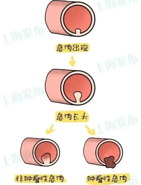 肠长了息肉有什么症状,肠里有息肉是怎么造成的