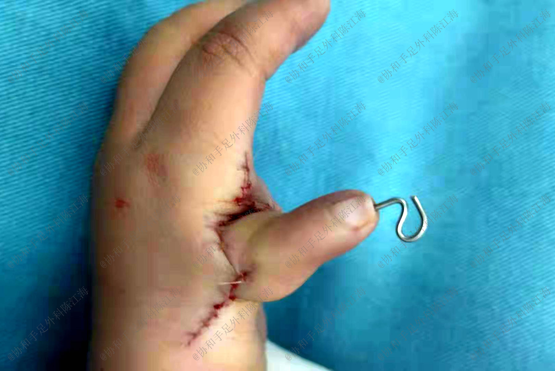 宝宝拇指不能伸直怎么回事,宝宝手部握拳没力气