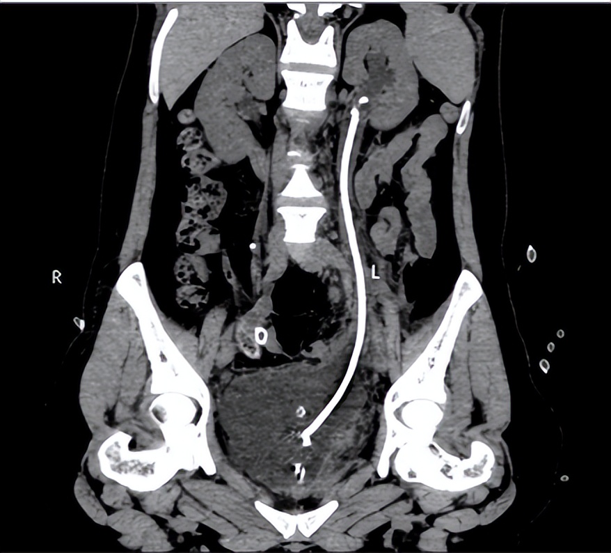 达芬奇系列|哈医大一院泌尿外科王春阳机器人团队巧用膀胱肌瓣重建输尿管助女性解除阴道漏尿困扰