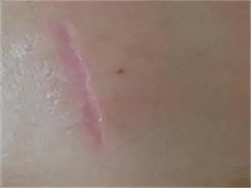 疤痕膏哪个牌子最好最有效,疤痕膏和疤痕贴哪个更好