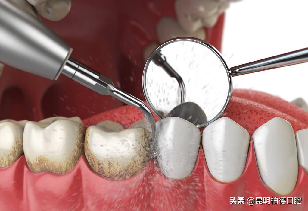 洗牙里面喷砂和抛光有什么区别,洗牙抛光和喷砂抛光的区别