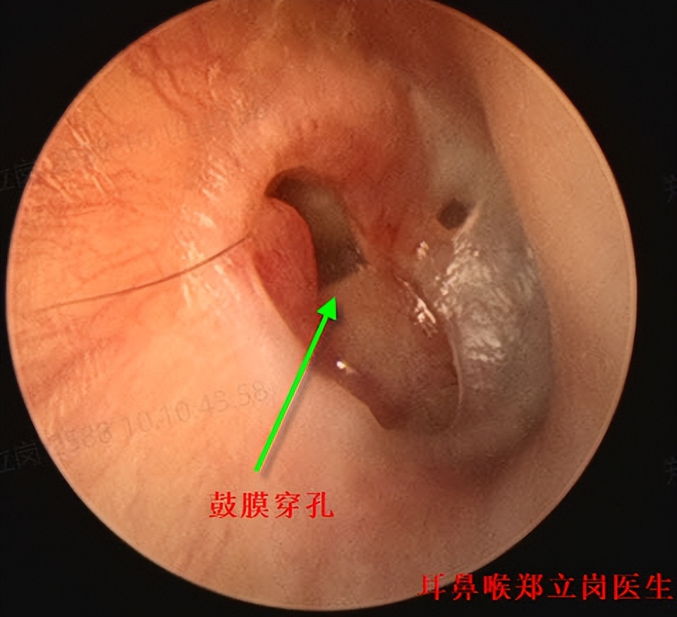 中耳炎为什么要做鼻中隔手术,中耳炎为什么要做手术