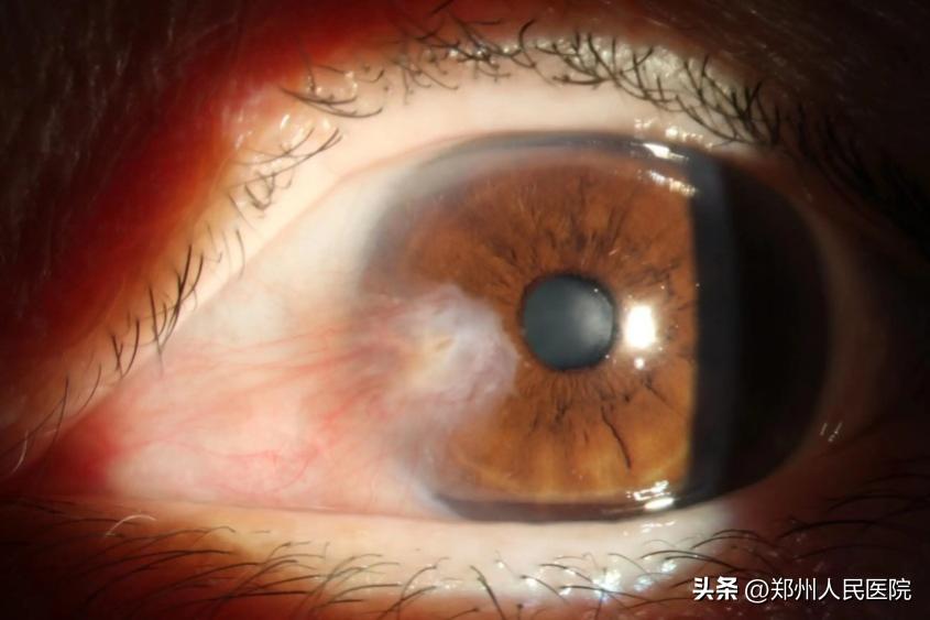 眼球突出恐怖图,眼球上长黄色凸起物怎么回事