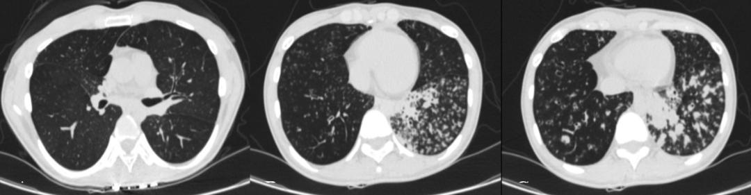 婴儿间断性咳嗽是怎么回事,儿童咳嗽肺部有微小结节有事吗