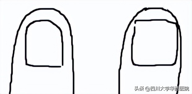 华西专家说，不是转你们，起码有一半的人从没有剪对过指甲儿！