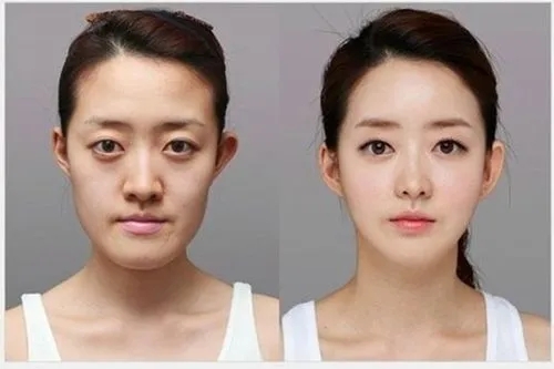 20岁中国女子赴韩整容身亡，韩国整容市场多疯狂？曾现幽灵手术