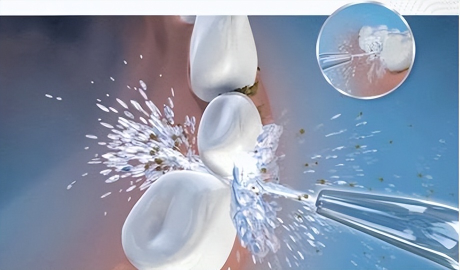 冲牙器的副作用与危害,警惕冲牙器的危害与副作用