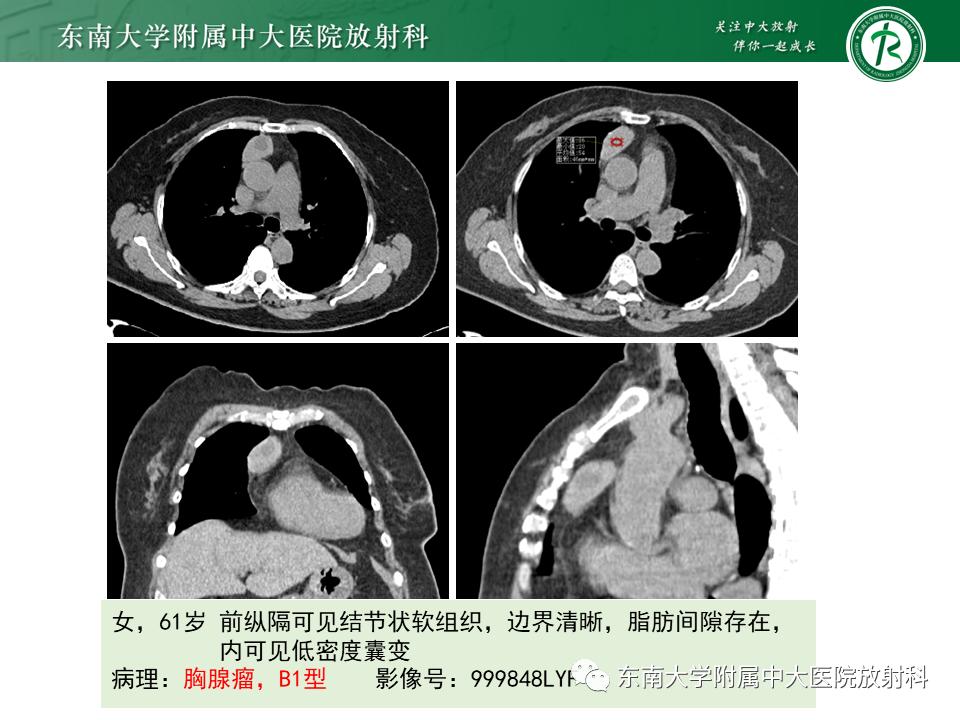 好文分享值得深思,纵隔精原细胞瘤