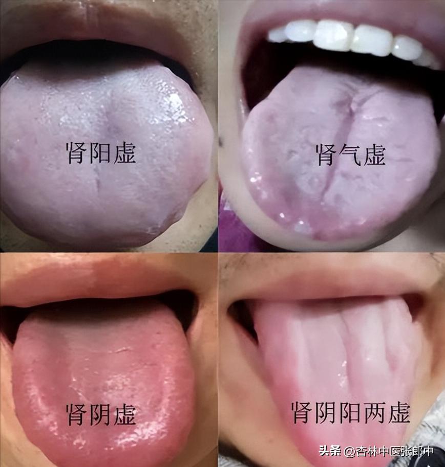 肾虚，不怕把病治反，就一味的补吧！调肾，实际就像调解夫妻吵架