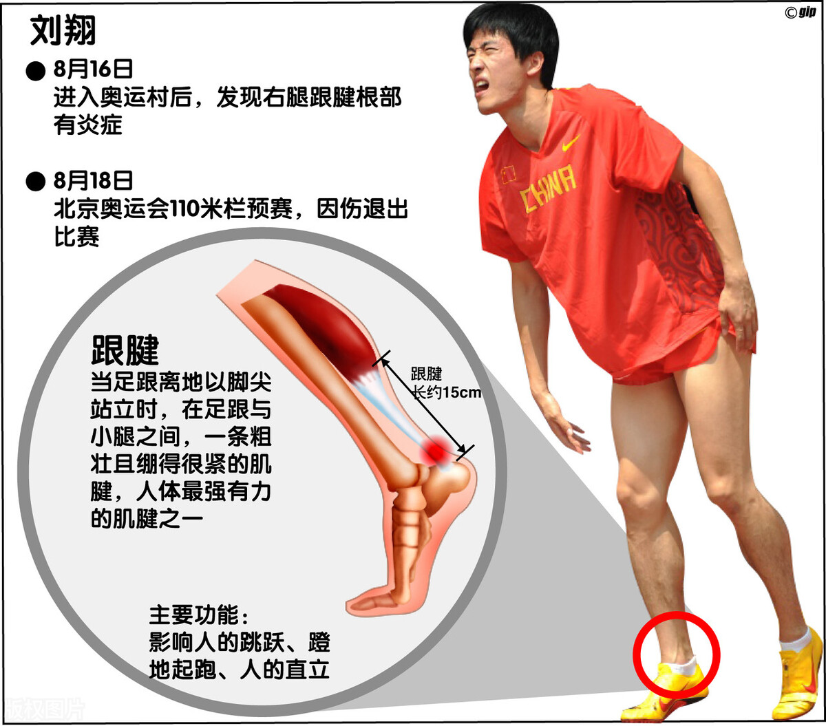 运动员跟腱断裂能恢复到100%吗,足球运动员跟腱断裂影响大吗